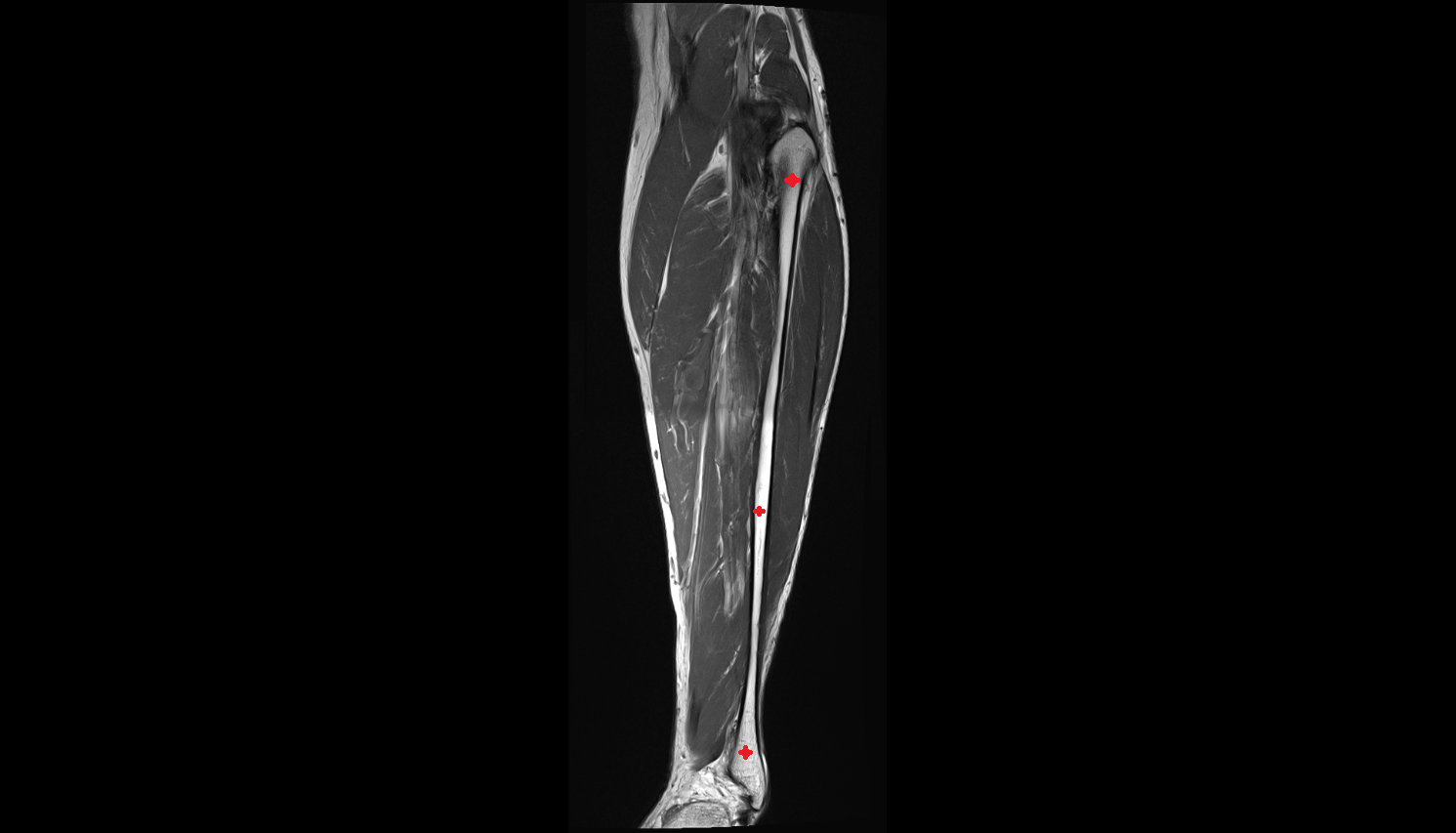 fibula coronal cross sectional anatomy 3T MRI AI enhanced  radiology  anatomy image-img-00000-00000