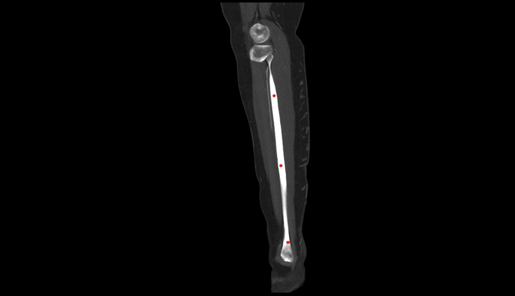 fibula sag cti image