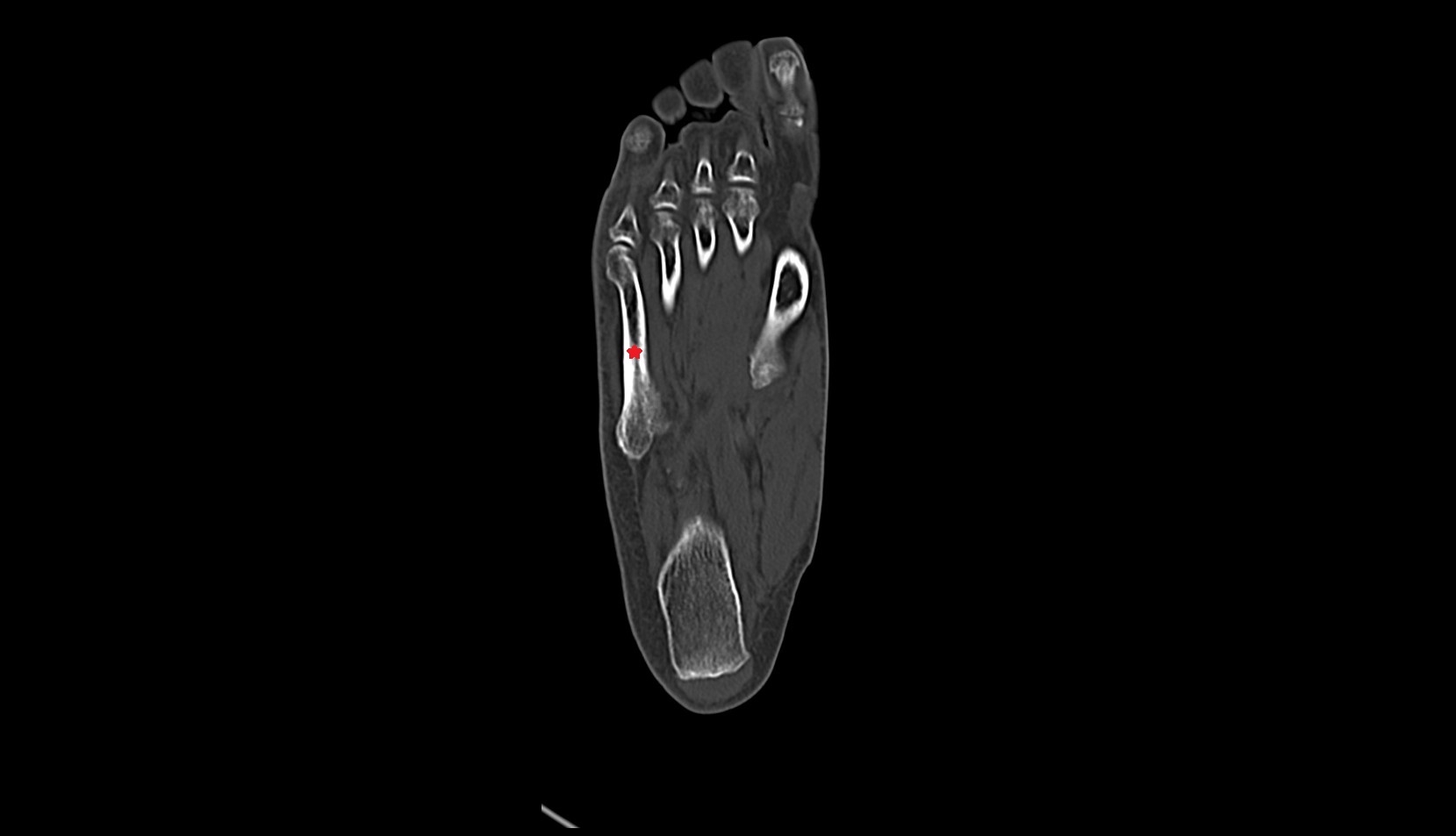 fifth Metatarsal Bone ct axial