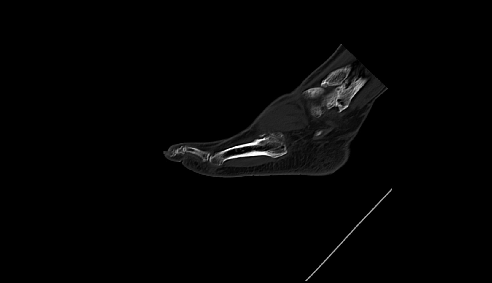 fifth Metatarsal Bone ct sag
