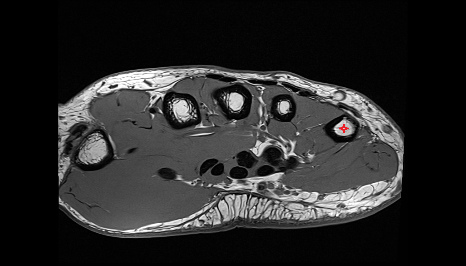 fifth metacarpal bone (metacarpal V)  AXIAL cross sectional anatomy 3T MRI AI enhanced radiology image-img-00000-00000