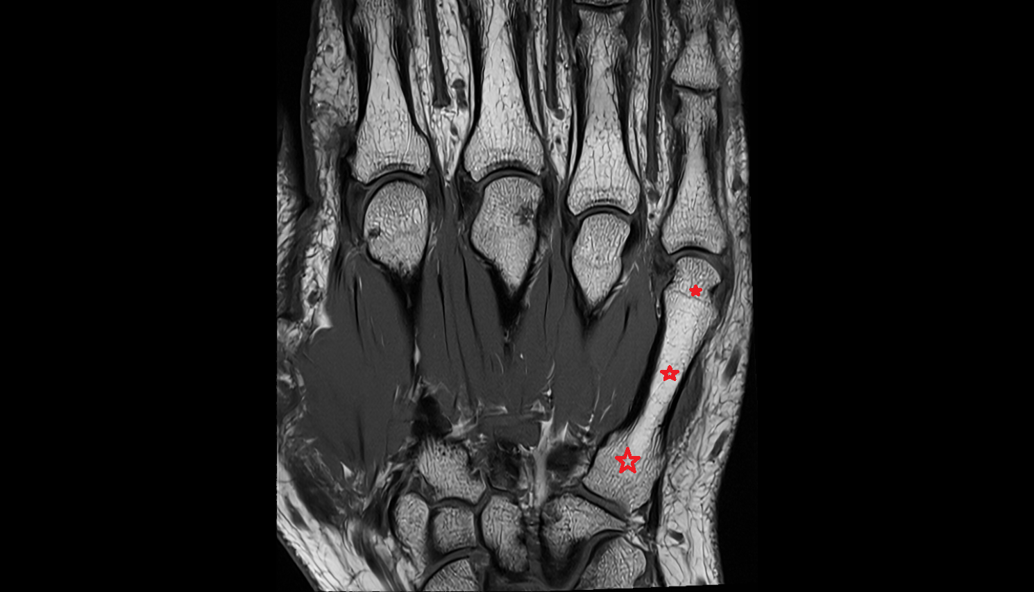 fifth metacarpal bone (metacarpal V)  coronal cross sectional anatomy 3T MRI AI enhanced radiology image-img-00000-00000