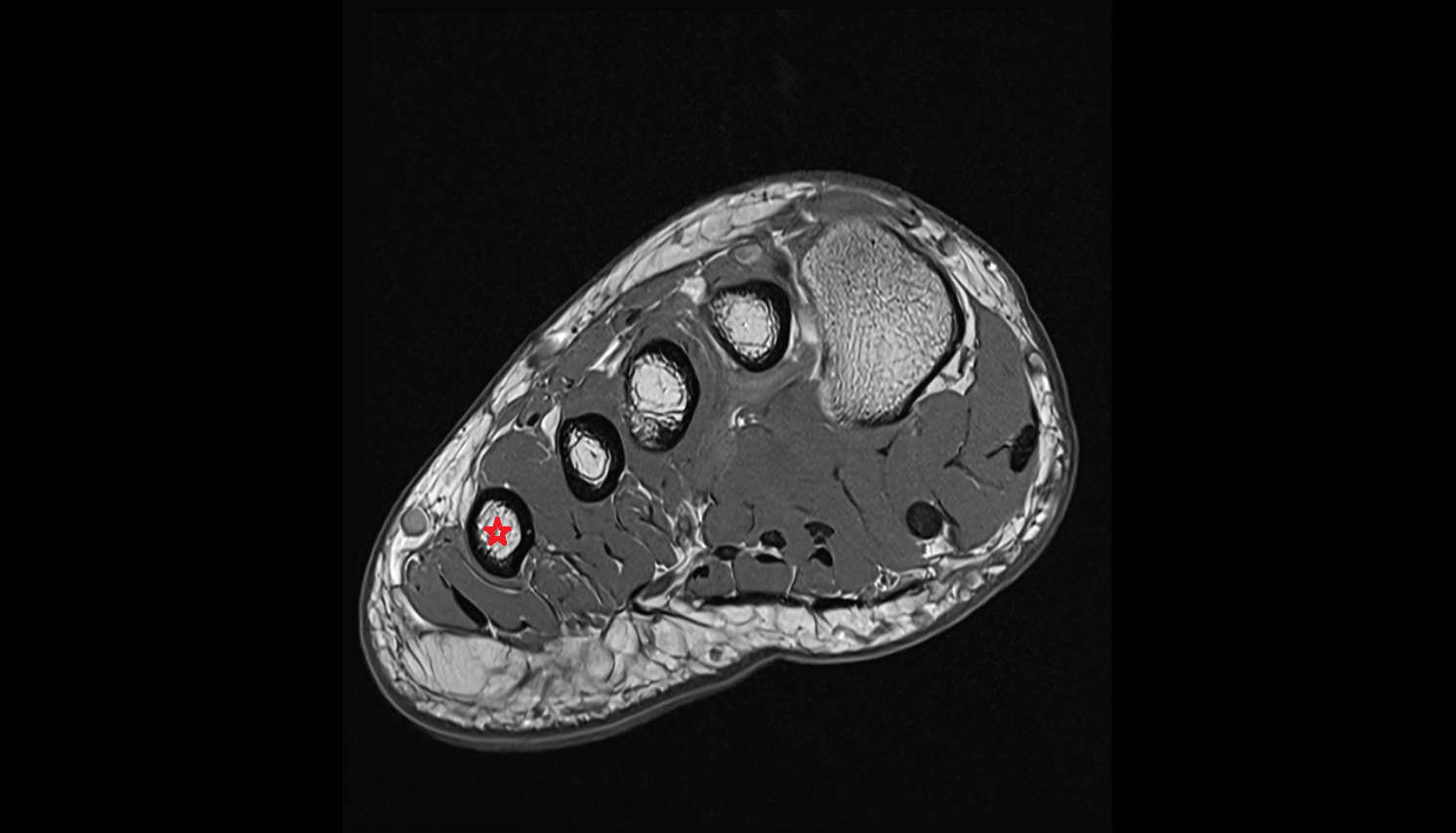 fifth  metatarsal bone axial cross sectional anatomy 3T MRI AI enhanced radiology image-img-00000-00000