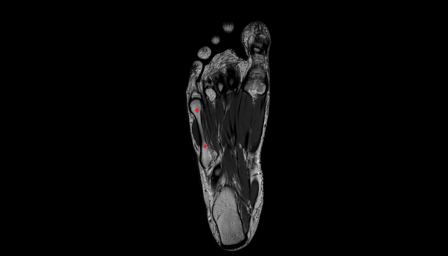 fifth  metatarsal bone axial cross sectional anatomy 3T MRI AI enhanced radiology image-img-00000-00000_00001