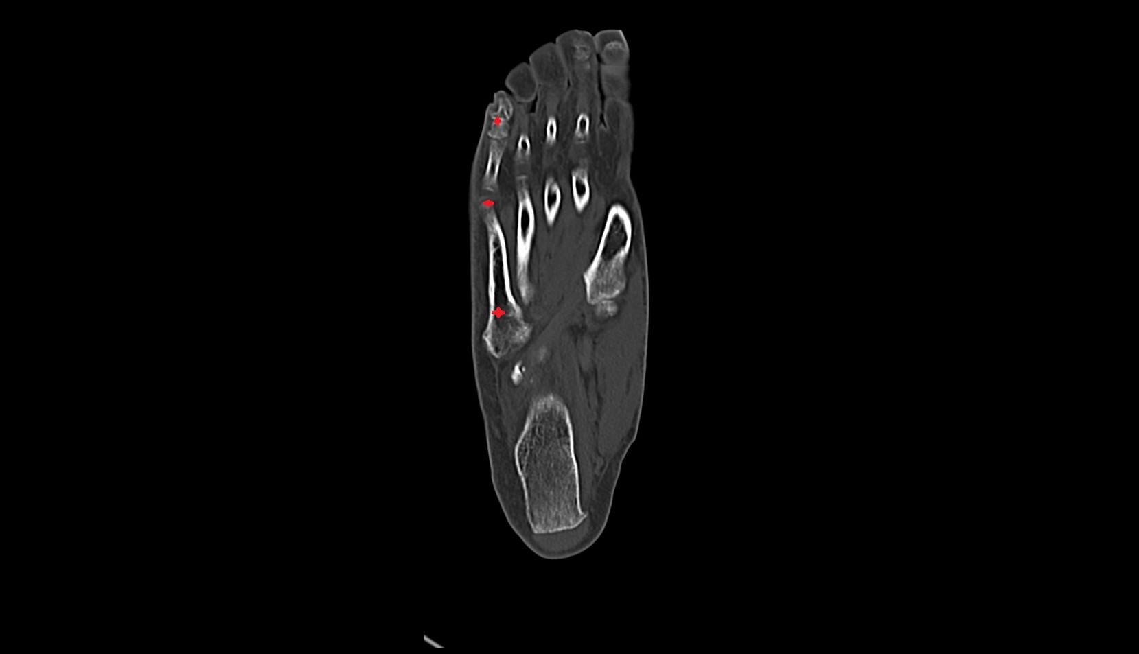 fifth  toe CT coronal image