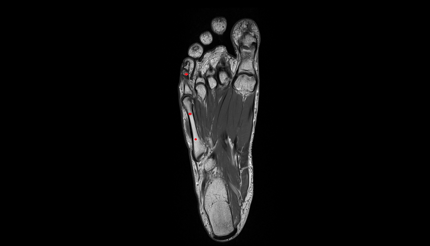 fifth toe of foot axial cross sectional anatomy 3T MRI AI enhanced radiology image-img-00000-00000