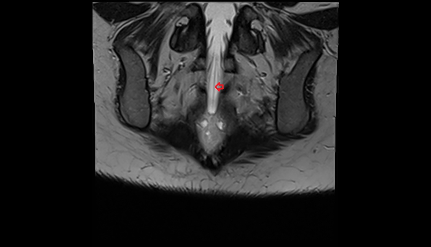 filum terminale internum  MRI coronal  anatomy  image-img-00000-00000