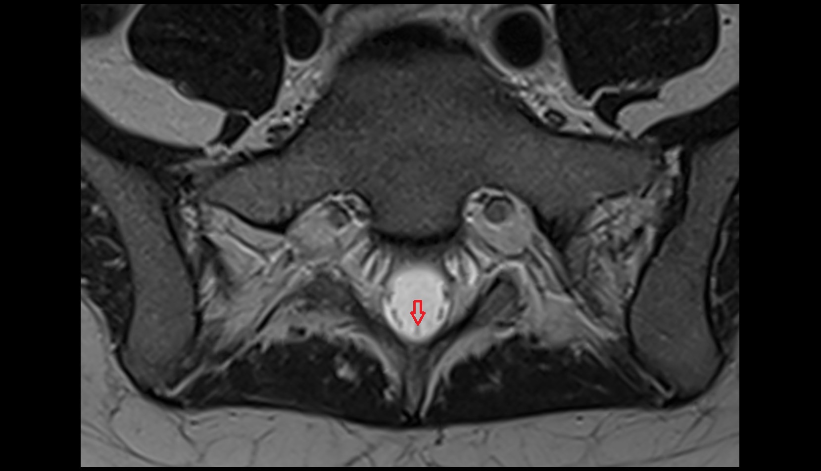 filum terminale internum mri axial image