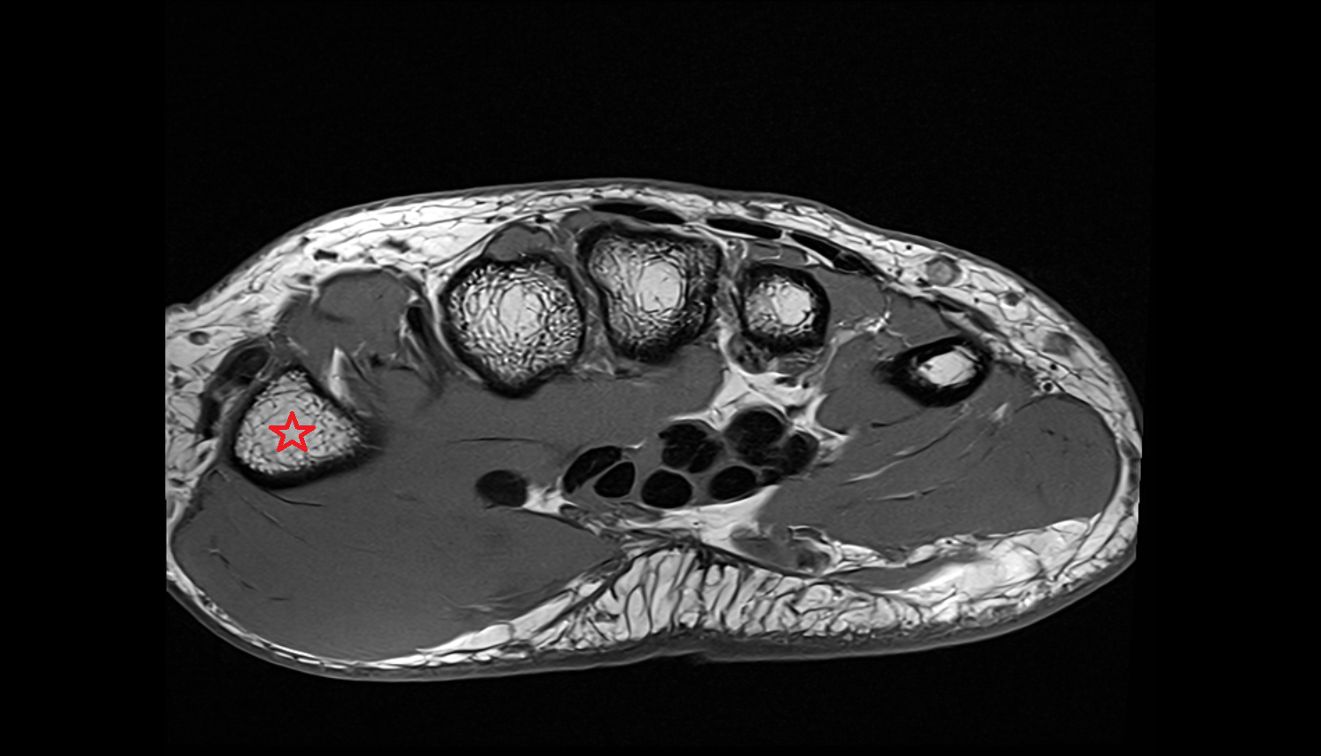 first metacarpal bone (metacarpal I)  AXIALl cross sectional anatomy 3T MRI AI enhanced radiology image-img-00000-00000