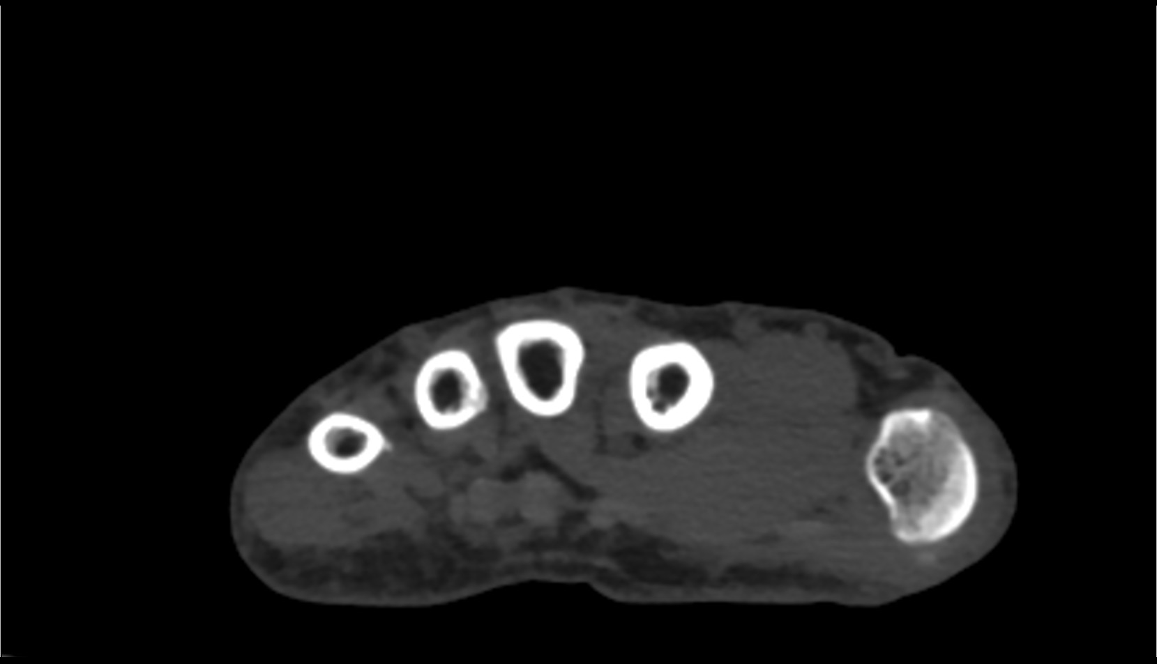 first metacarpal bone (metacarpal I) ct axial image