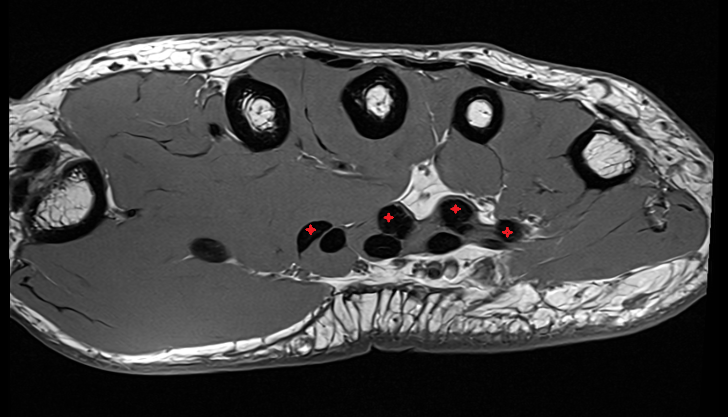 flexor digitorum profundus tendon axial cross sectional anatomy 3T MRI AI enhanced radiology image-img-00000-00000