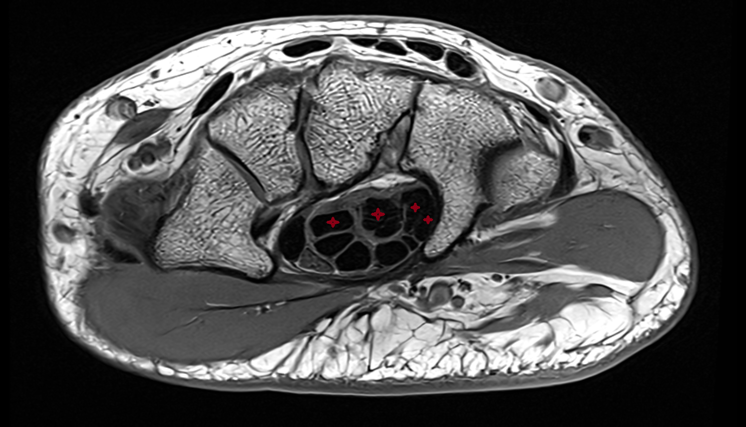 flexor digitorum profundus tendon axial cross sectional anatomy 3T MRI AI enhanced radiology image-img-00000-00000_00002