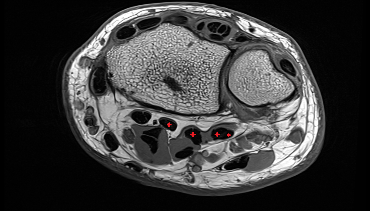 flexor digitorum profundus tendon axial cross sectional anatomy 3T MRI AI enhanced radiology image-img-00000-00000_00003