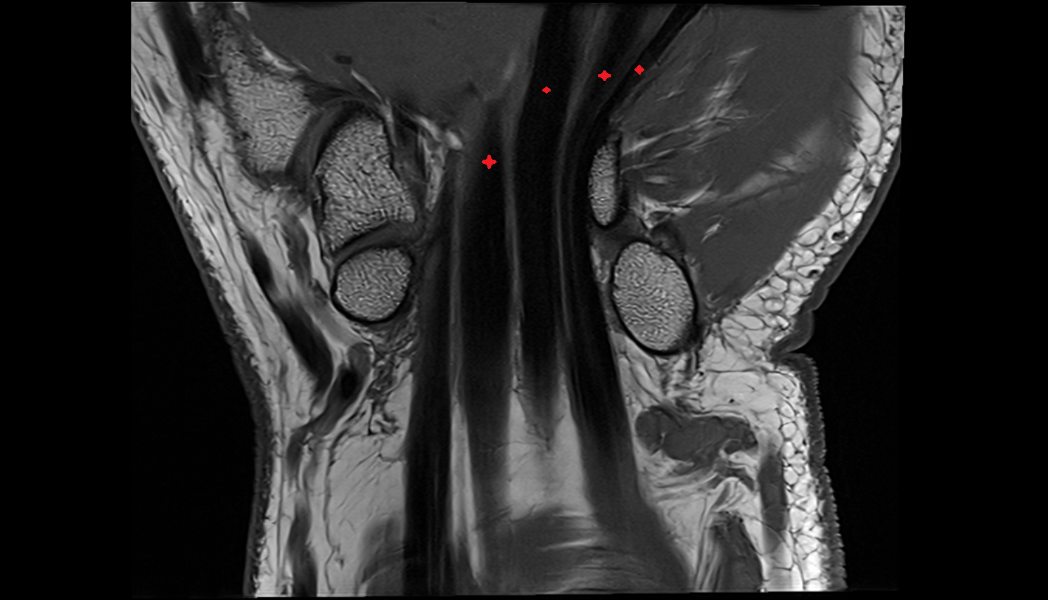 flexor digitorum profundus tendon coronal cross sectional anatomy 3T MRI AI enhanced radiology image-img-00000-00000
