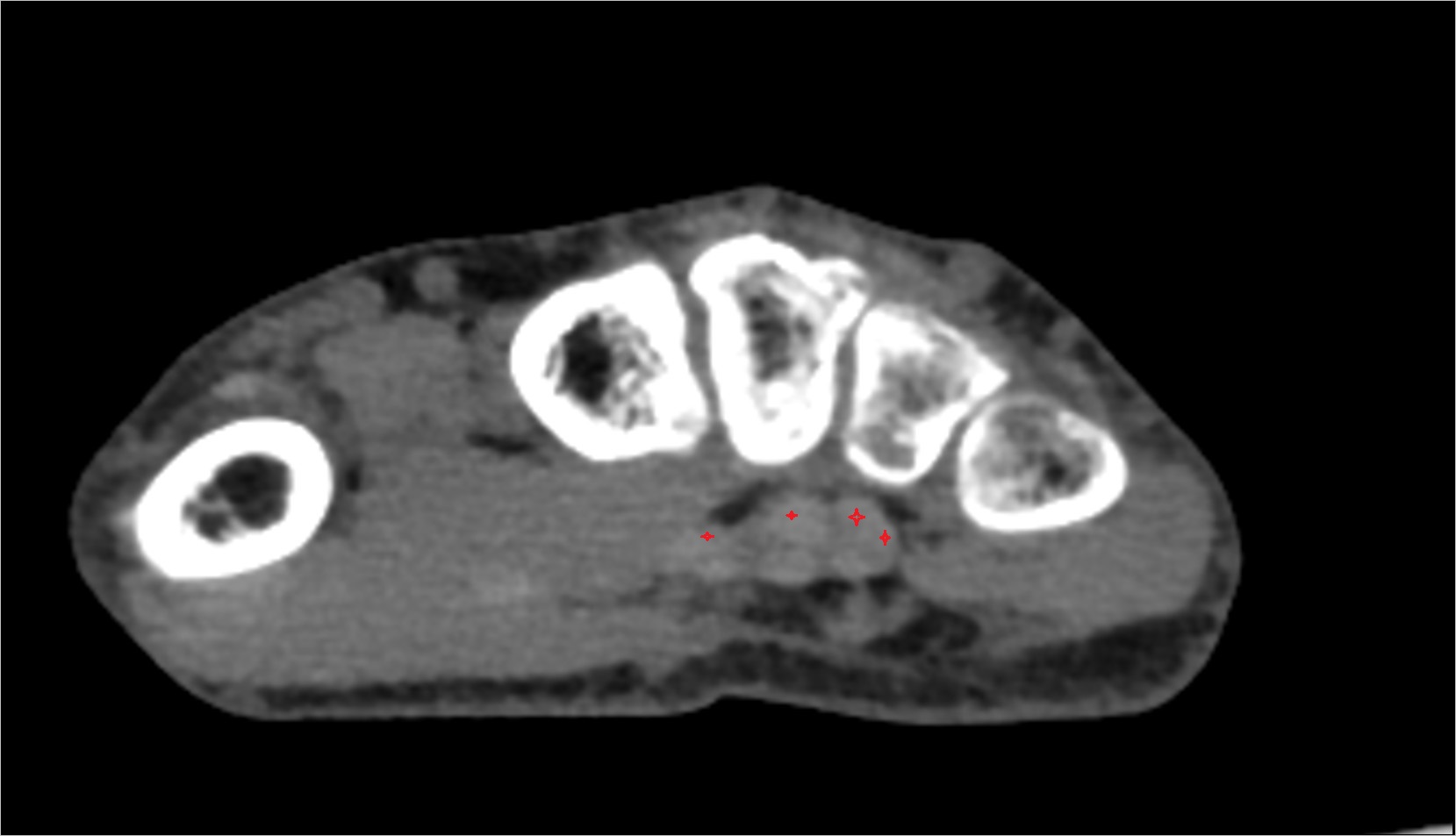 flexor digitorum profundus tendon ct axial 1