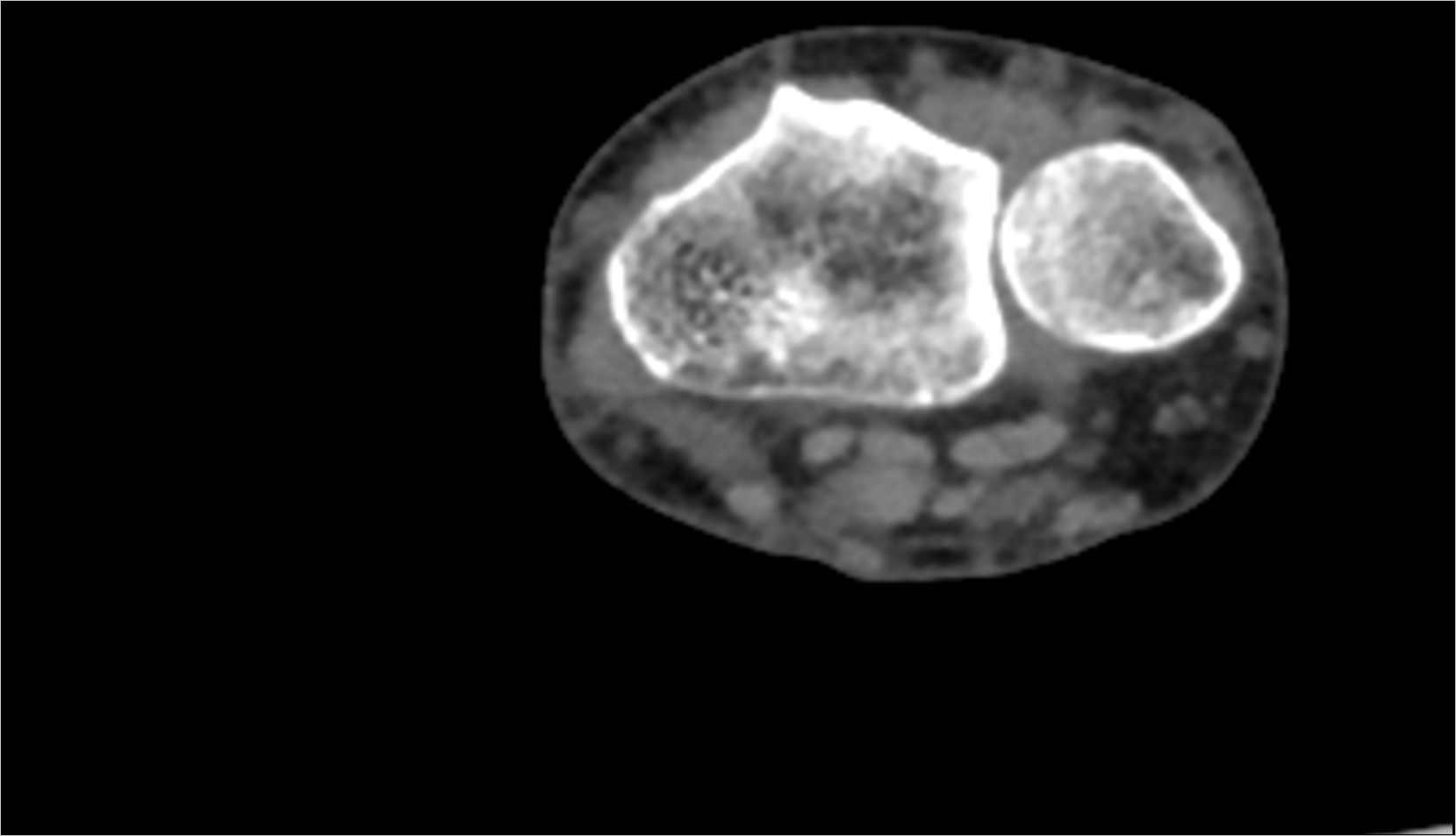 flexor digitorum superficialis tendon ct axial 1