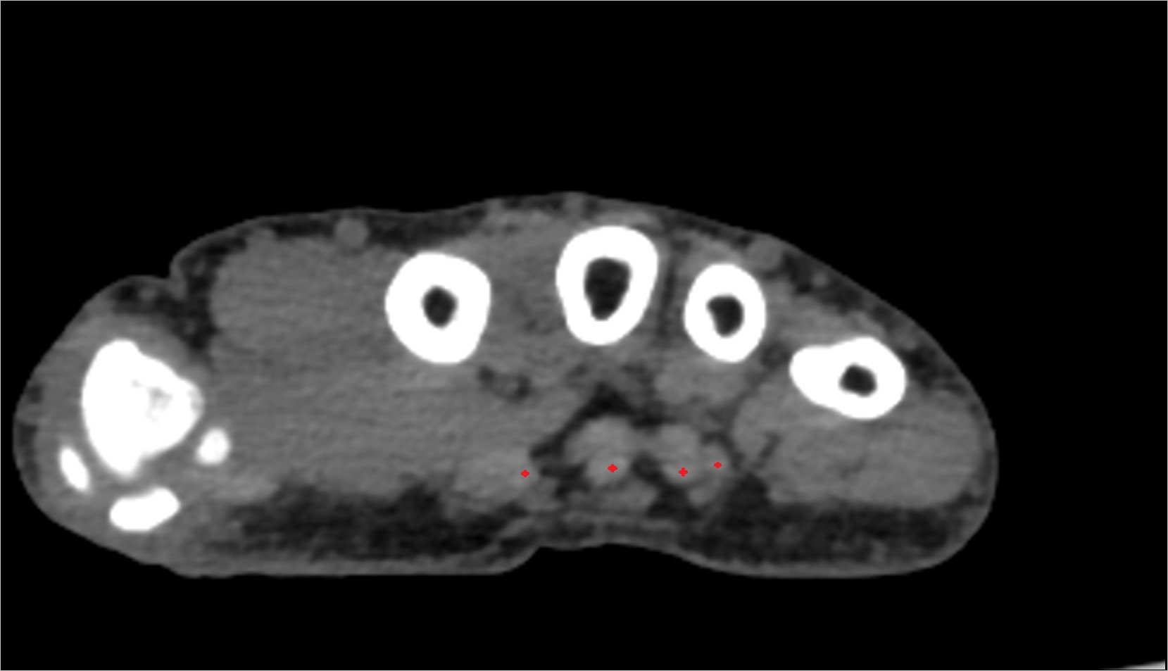 flexor digitorum superficialis tendon ct axial image