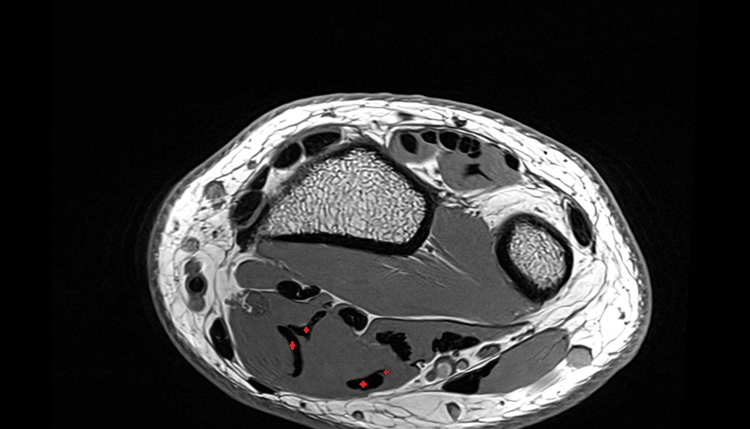 flexor digitorum superficialis tendons axial cross sectional anatomy 3T MRI AI enhanced radiology image-img-00000-00000