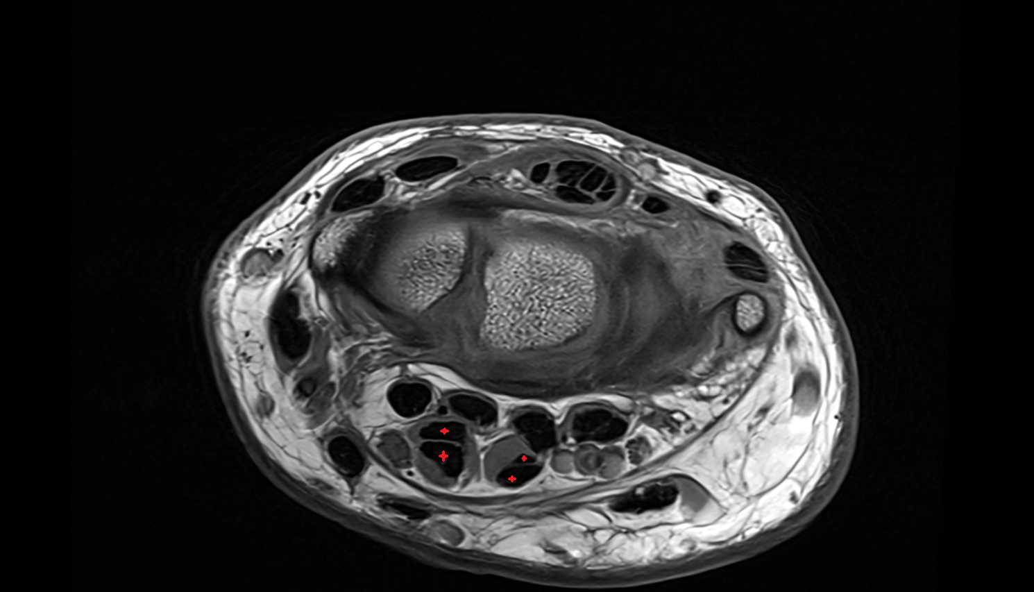 flexor digitorum superficialis tendons axial cross sectional anatomy 3T MRI AI enhanced radiology image-img-00000-00000_00001