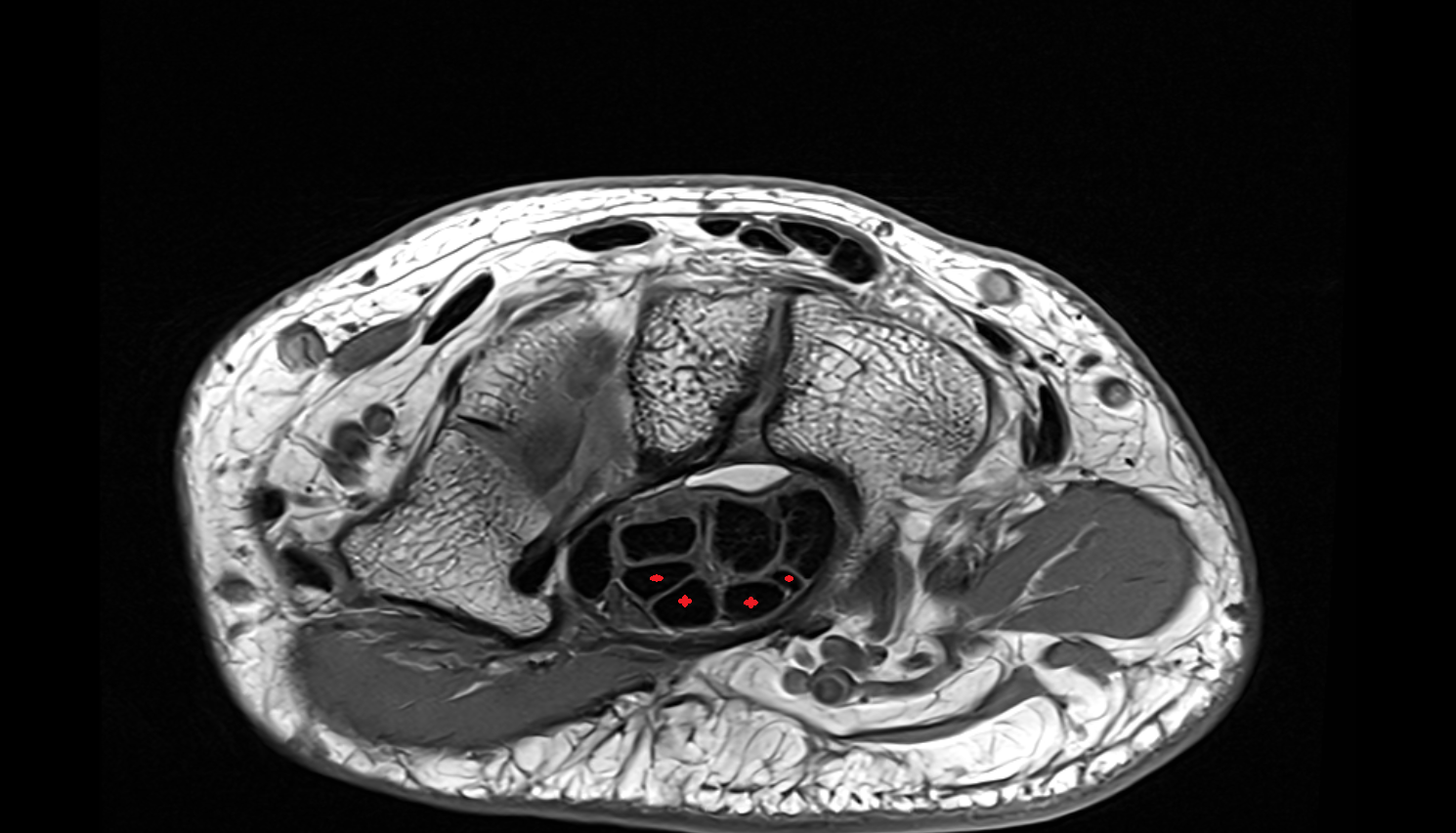 flexor digitorum superficialis tendons axial cross sectional anatomy 3T MRI AI enhanced radiology image-img-00000-00000_00002