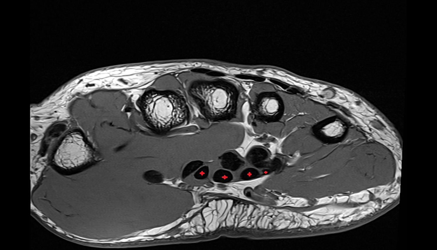 flexor digitorum superficialis tendons axial cross sectional anatomy 3T MRI AI enhanced radiology image-img-00000-00000_00003