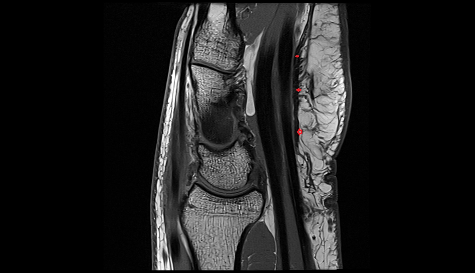 flexor retinaculum of wrist MRI sagittal image