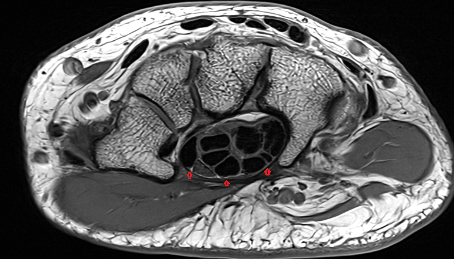 flexor retinaculum of wrist  axial cross sectional anatomy 3T MRI AI enhanced radiology image-img-00000-00000