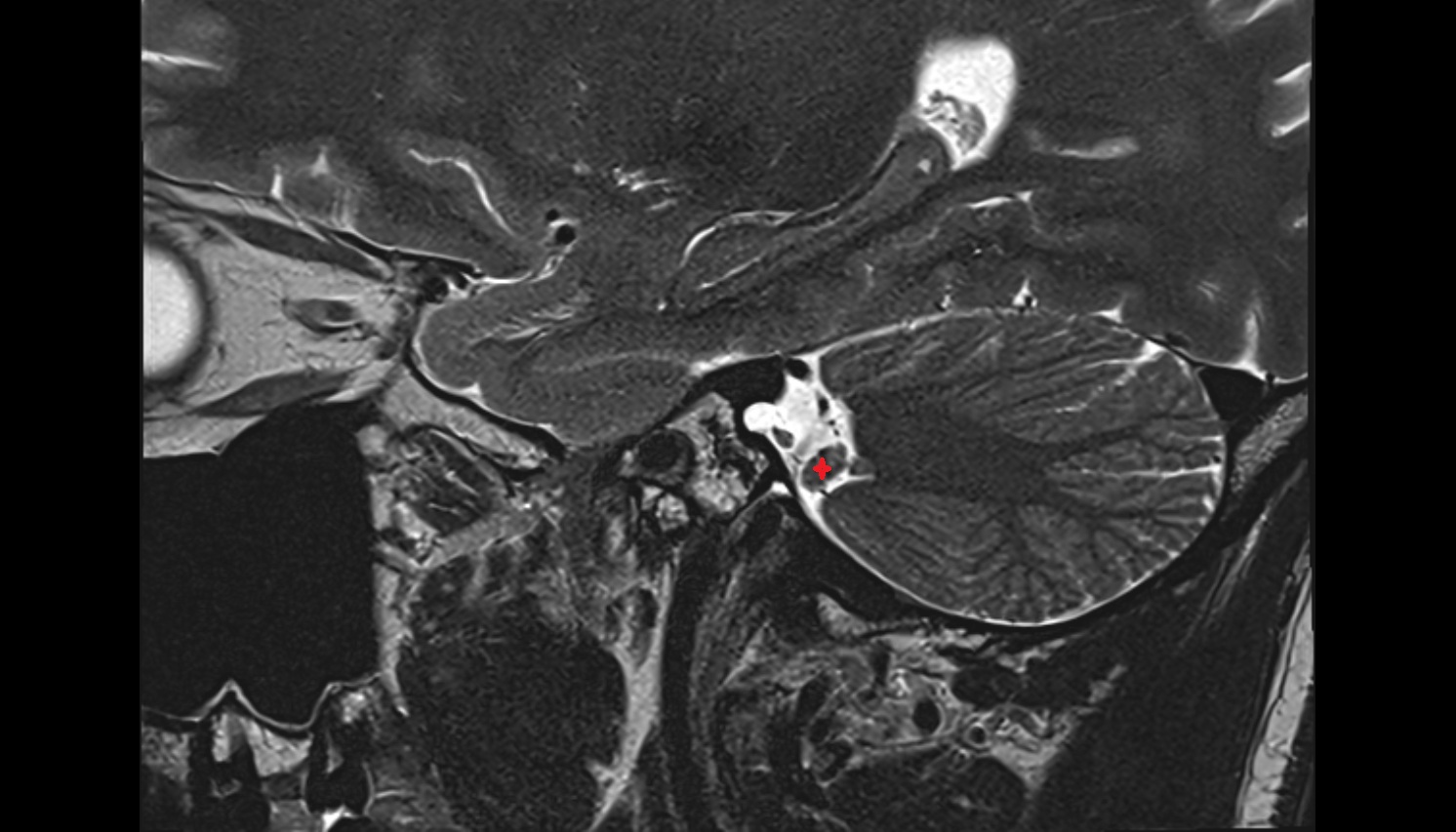 flocculus of cerebellum  mri sag  image -img-00000-00000