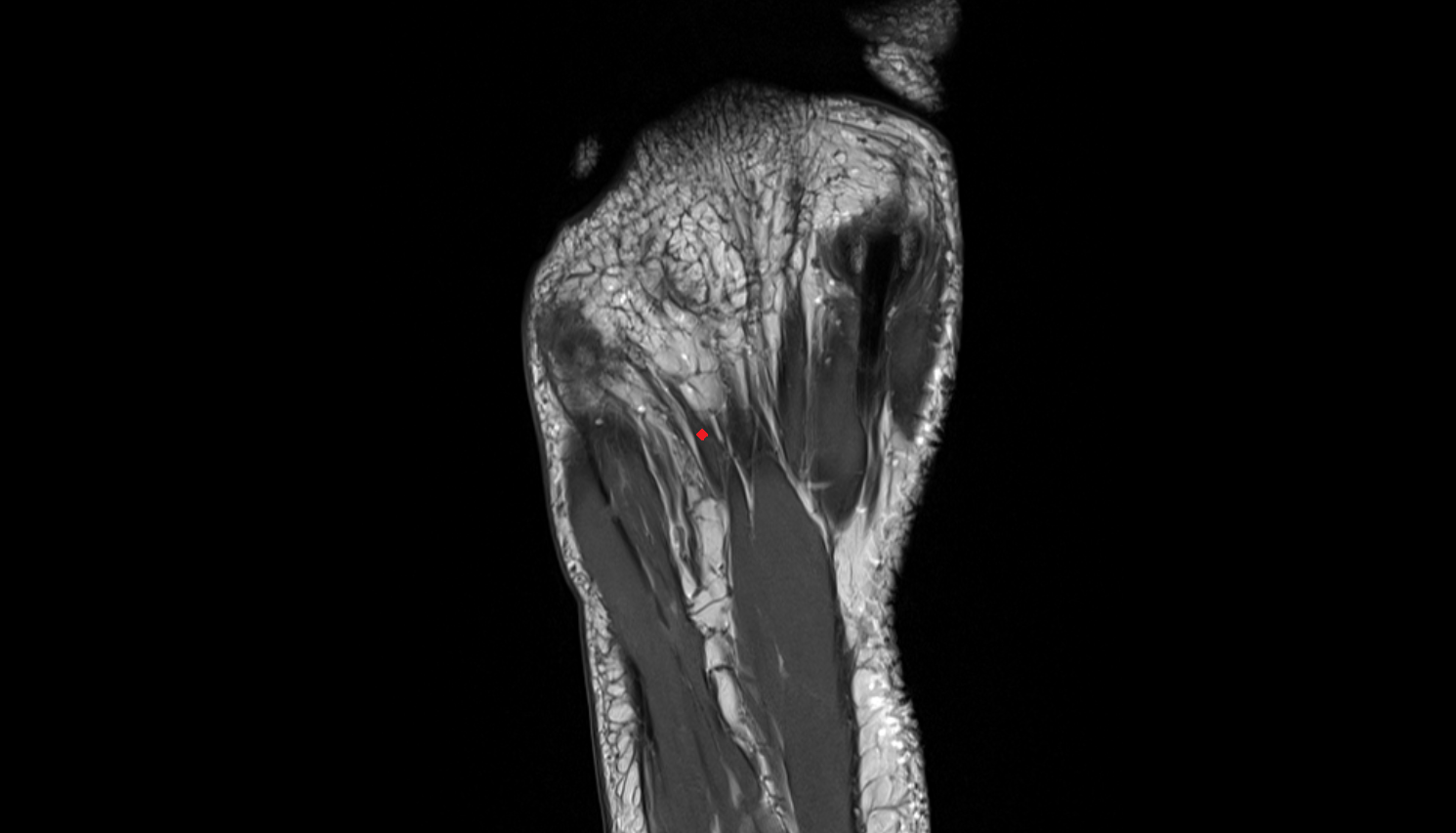 fourth Lumbrical Muscle of the Foot  axial cross sectional anatomy 3T MRI AI enhanced radiology image-img-00000-00000