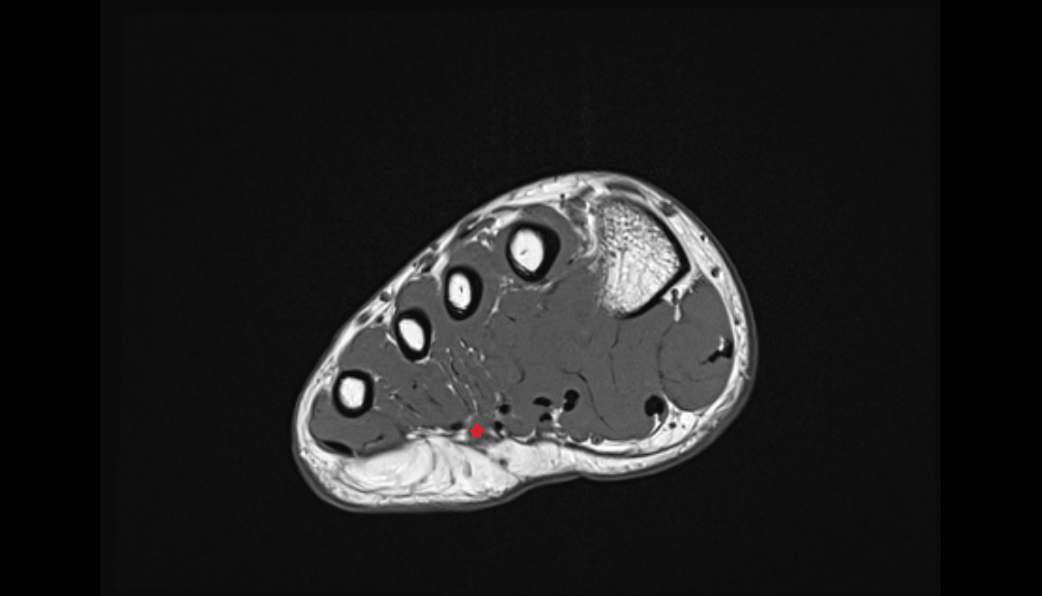 fourth Lumbrical Muscle of the Foot  axial cross sectional anatomy 3T MRI AI enhanced radiology image-img-00000-00000_00001
