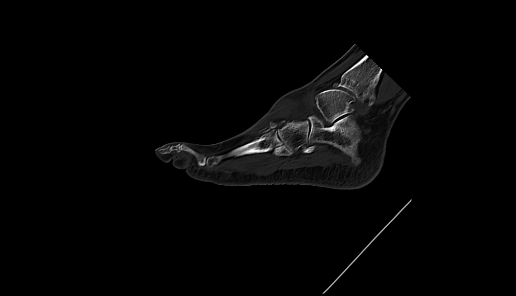 fourth Metatarsal Bone ct sag