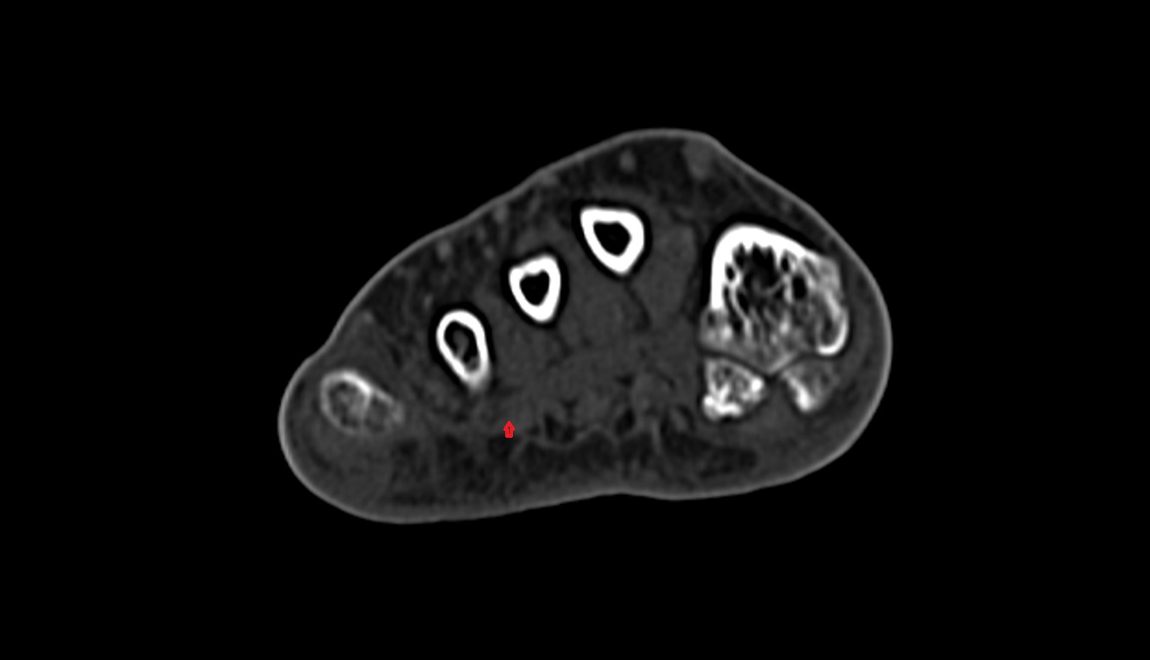 fourth lumbrical muscle of foot ct axial image