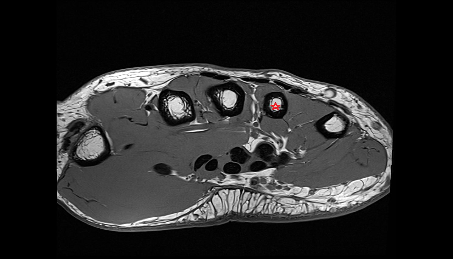 fourth metacarpal bone  AXIAL cross sectional anatomy 3T MRI AI enhanced radiology image-img-00000-00000