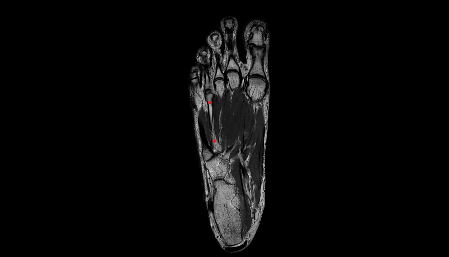 fourth  metatarsal bone coronal cross sectional anatomy 3T MRI AI enhanced radiology image-img-00000-00000