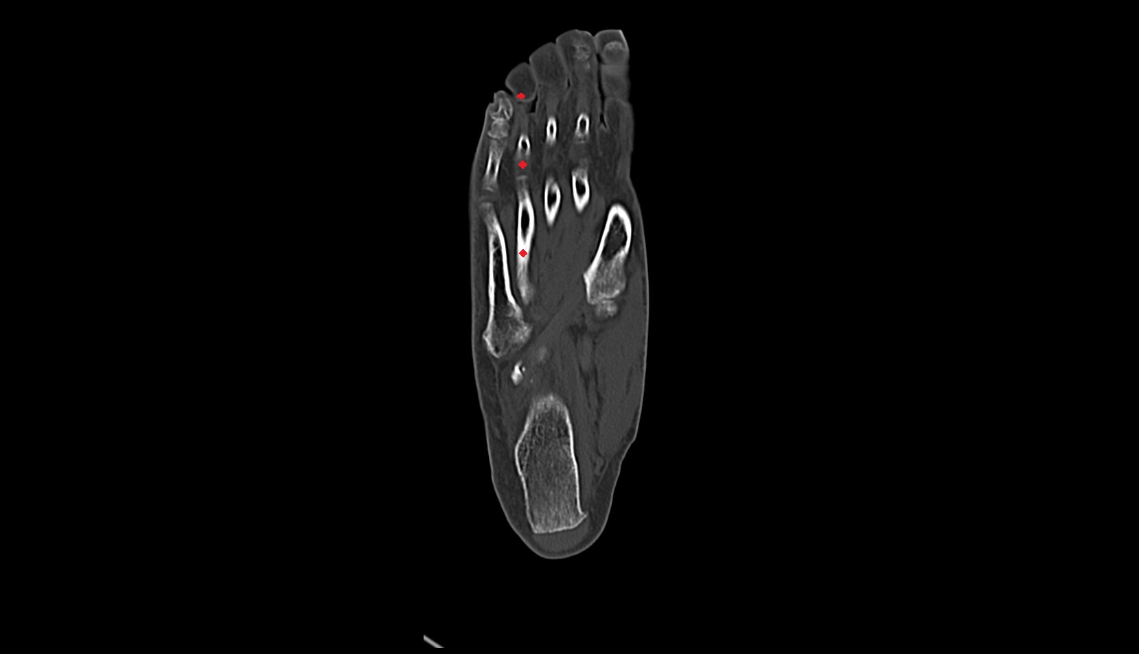fourth toe CT coronal image