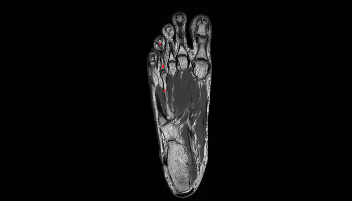 fourth toe of foot axial cross sectional anatomy 3T MRI AI enhanced radiology image-img-00000-00000