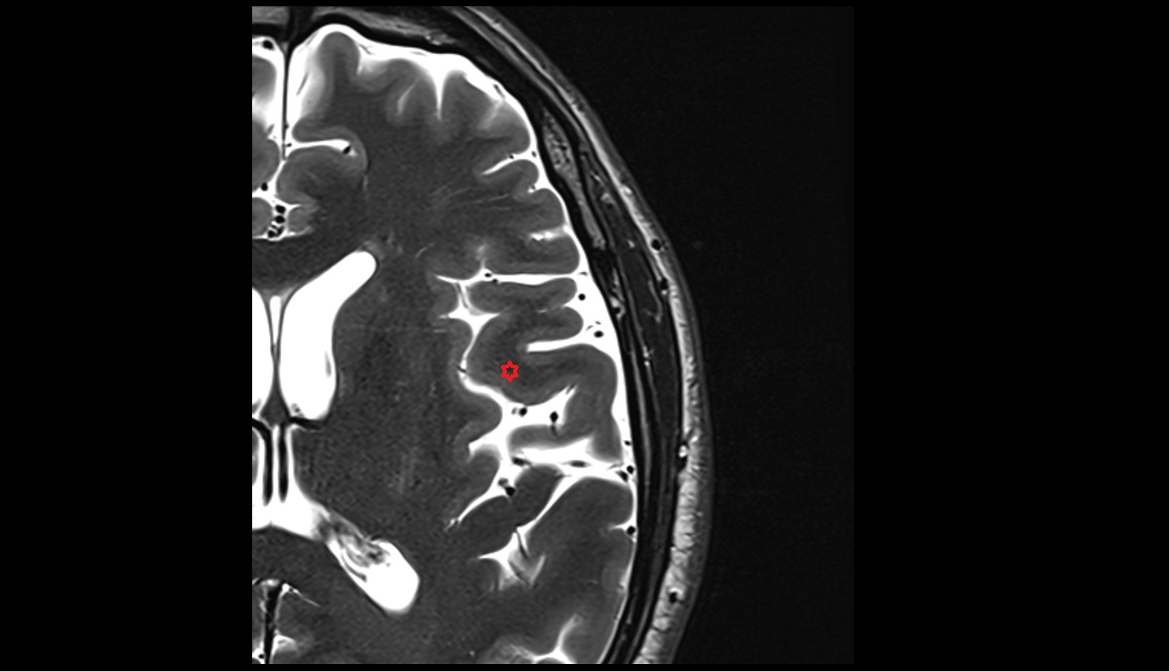 frontal operculum mri 3t axial image
