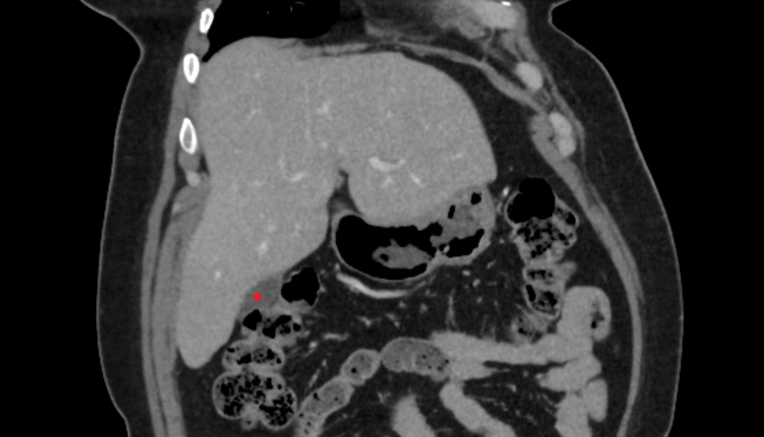 fundus of gallbladder  CT coronal  anatomy  image -img-00000-00000