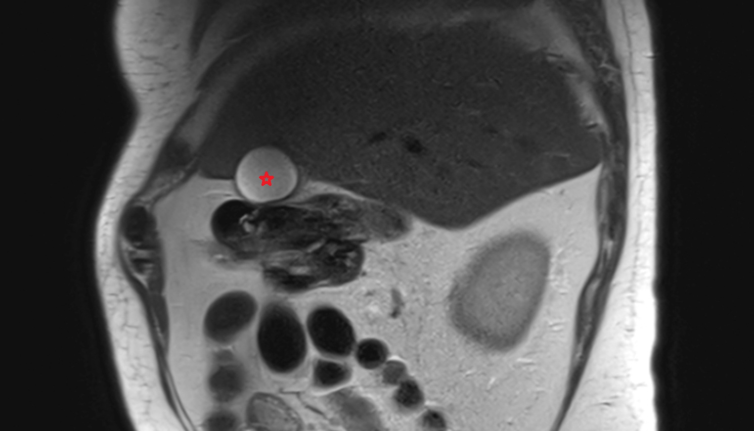 fundus of gallbladder  MRI sag anatomy  image -img-00000-00000