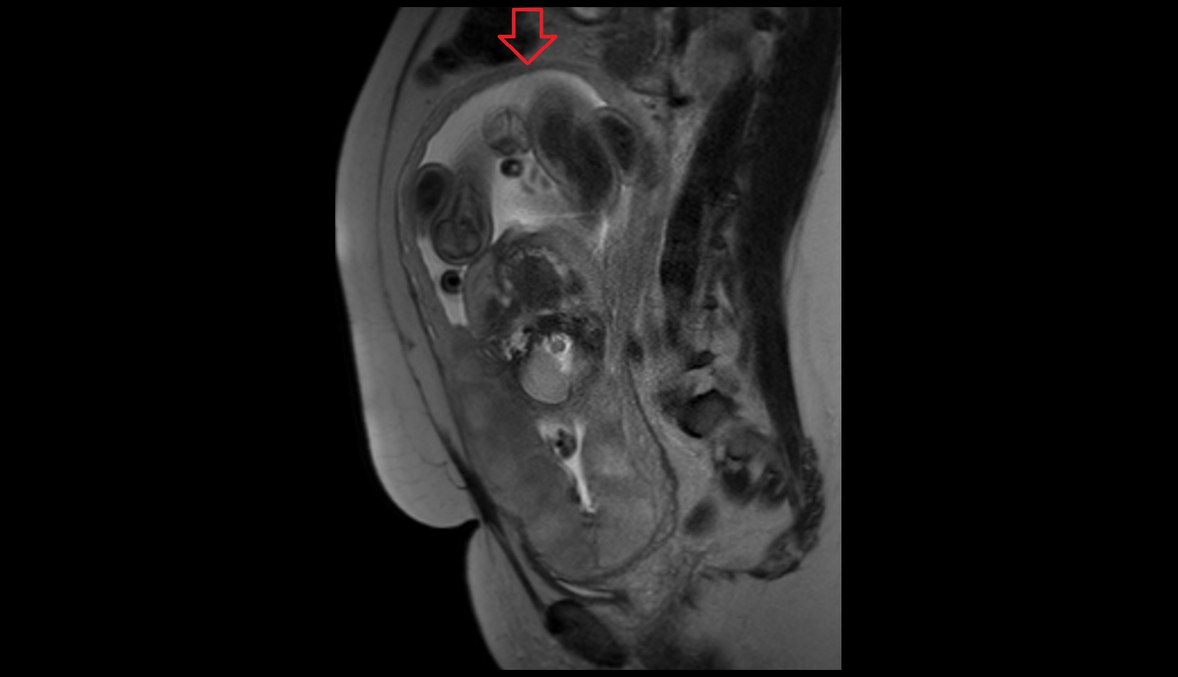 fundus of uterus in pregnancy
