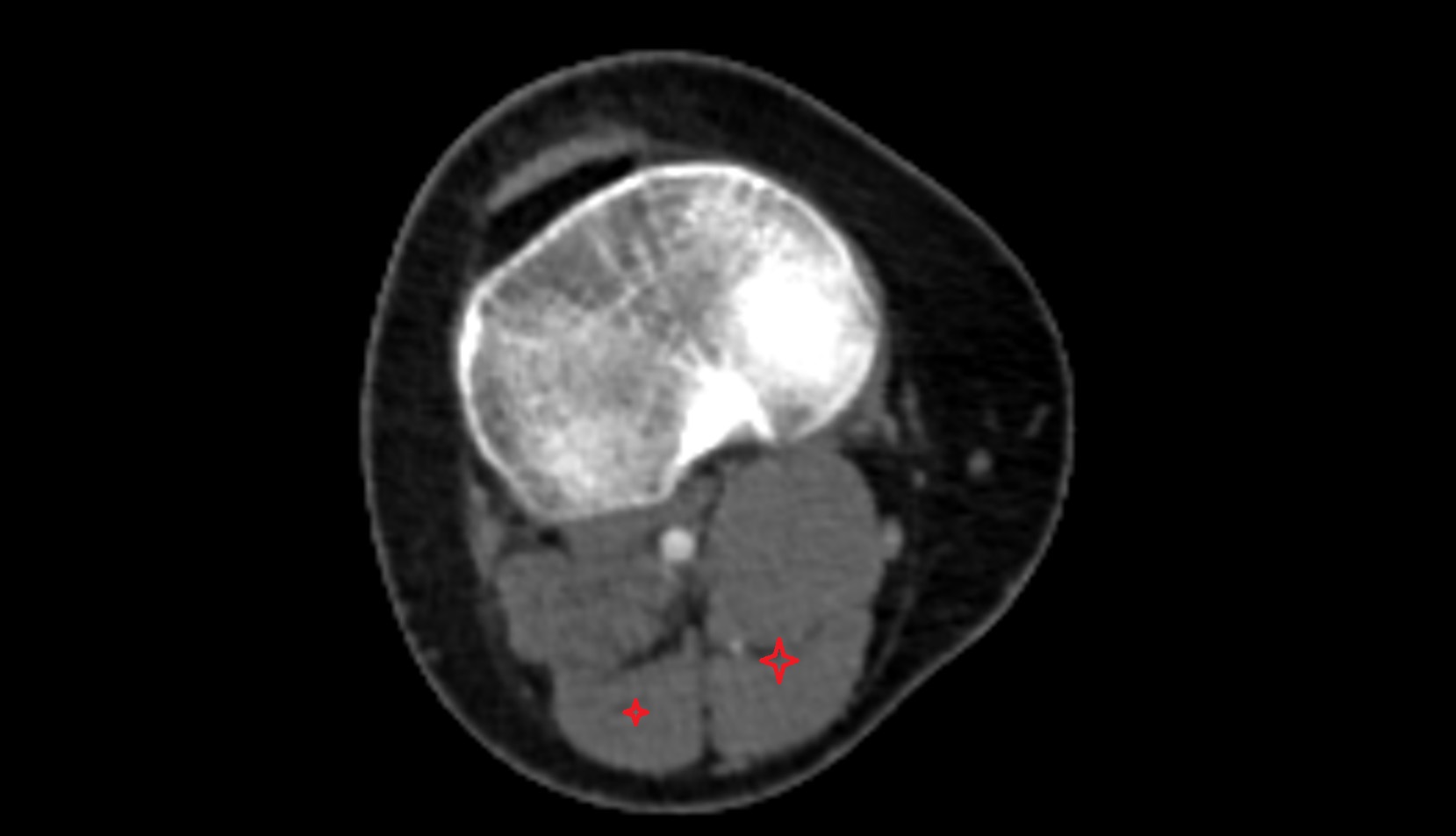 gastrocnemius muscle CT axial image