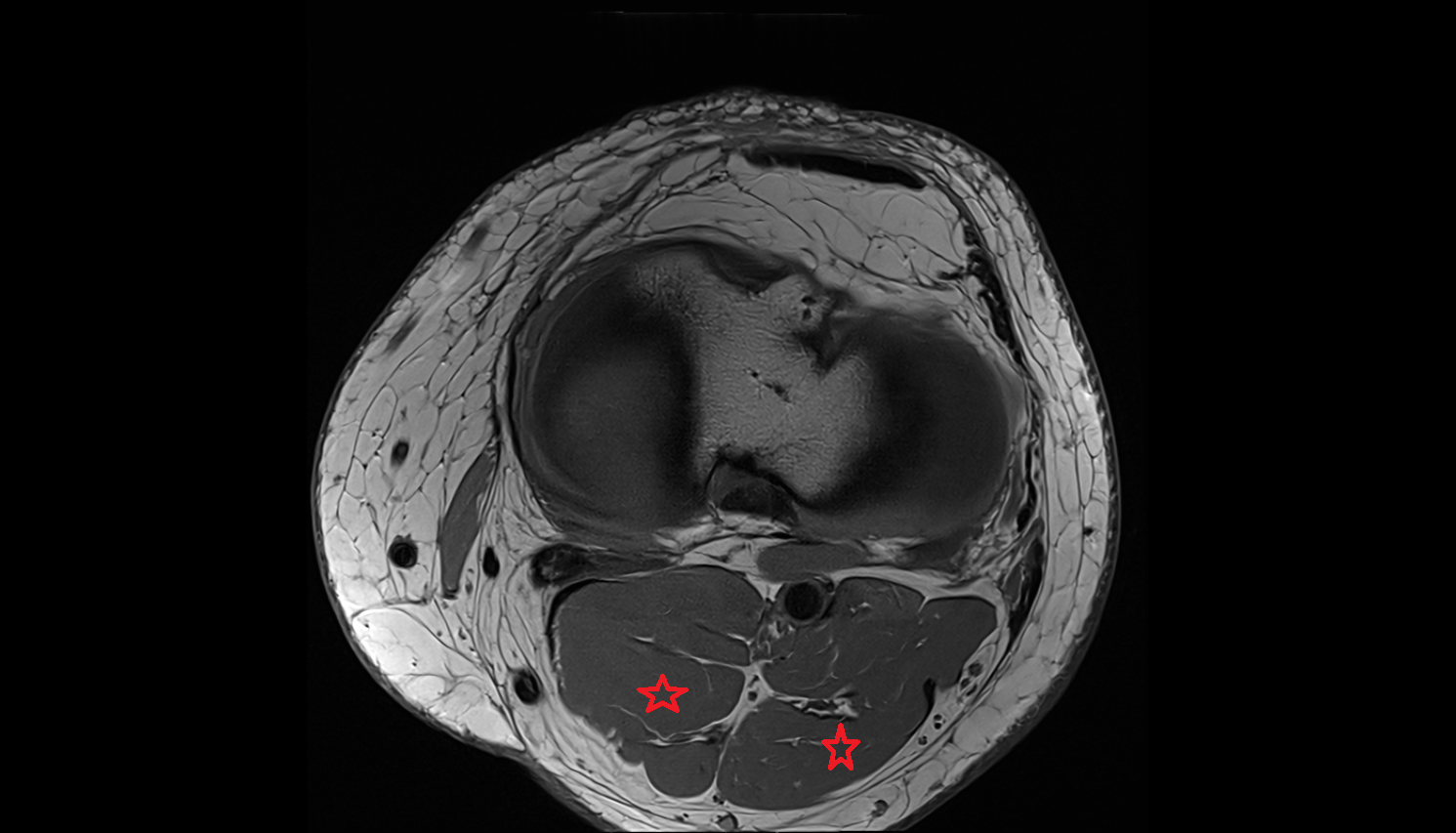 gastrocnemius muscle  axial  cross sectional anatomy 3T radiology  anatomy image-img-00000-00000