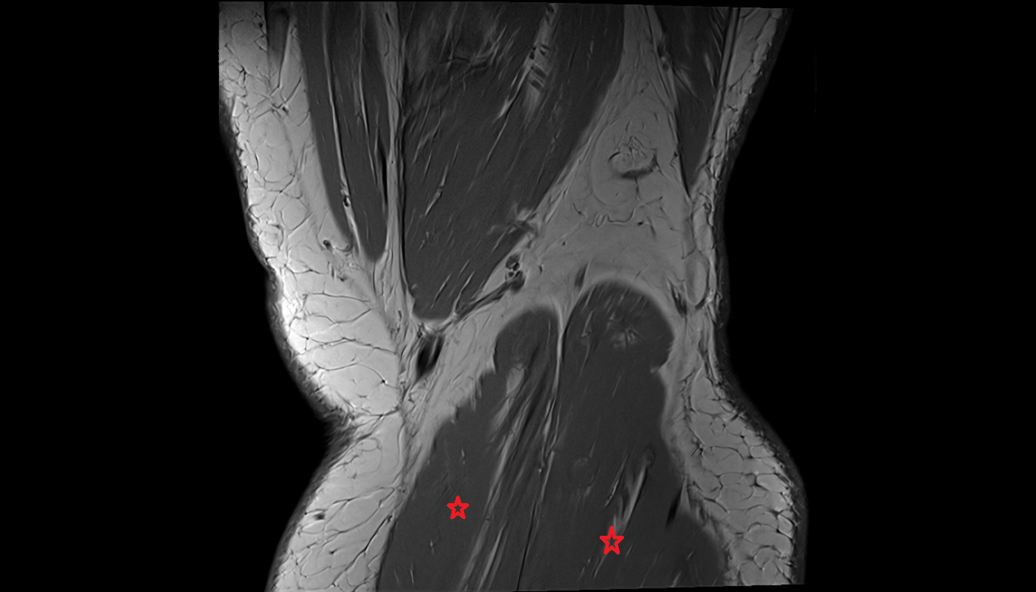 gastrocnemius muscle  coronal  cross sectional anatomy 3T radiology  anatomy image-img-00000-00000
