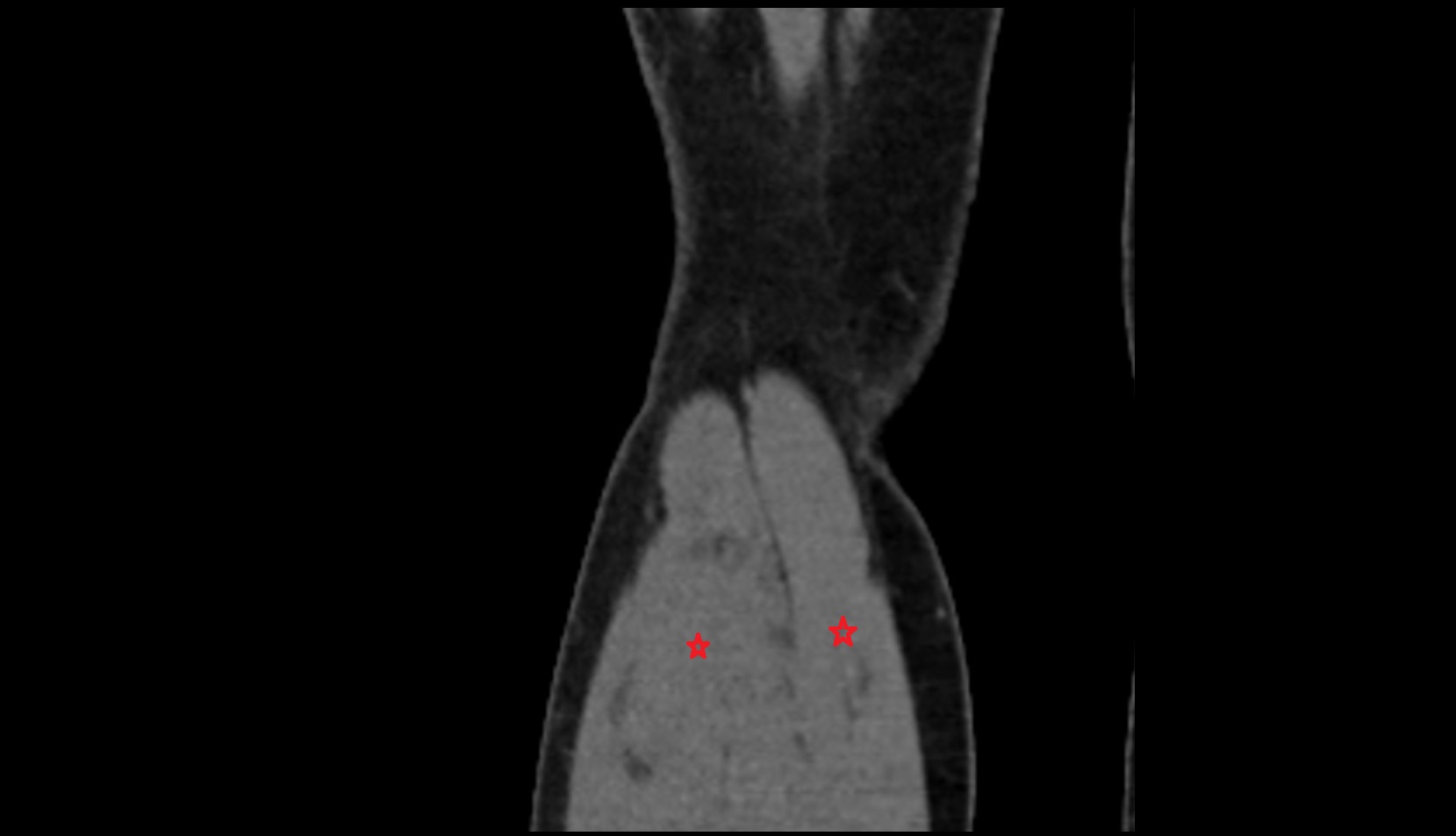 gastrocnemius muscle ct coronal image
