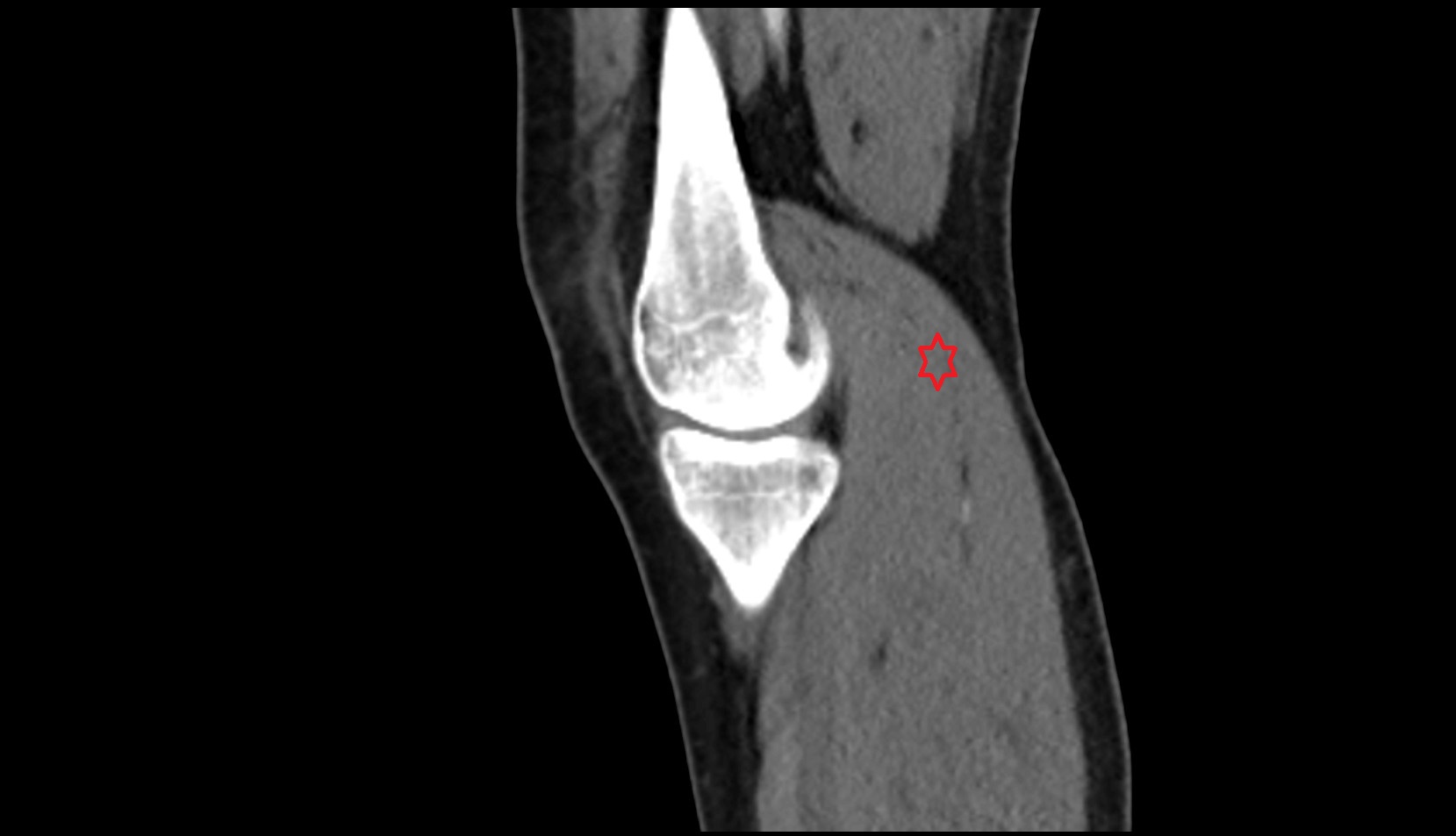 gastrocnemius muscle ct sag image