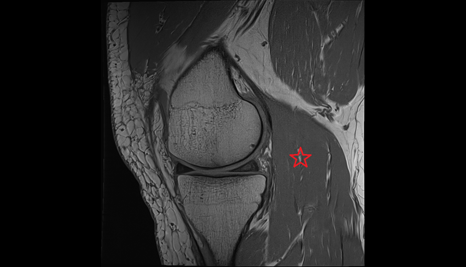 gastrocnemius muscle  sag cross sectional anatomy 3T radiology  anatomy image-img-00000-00000