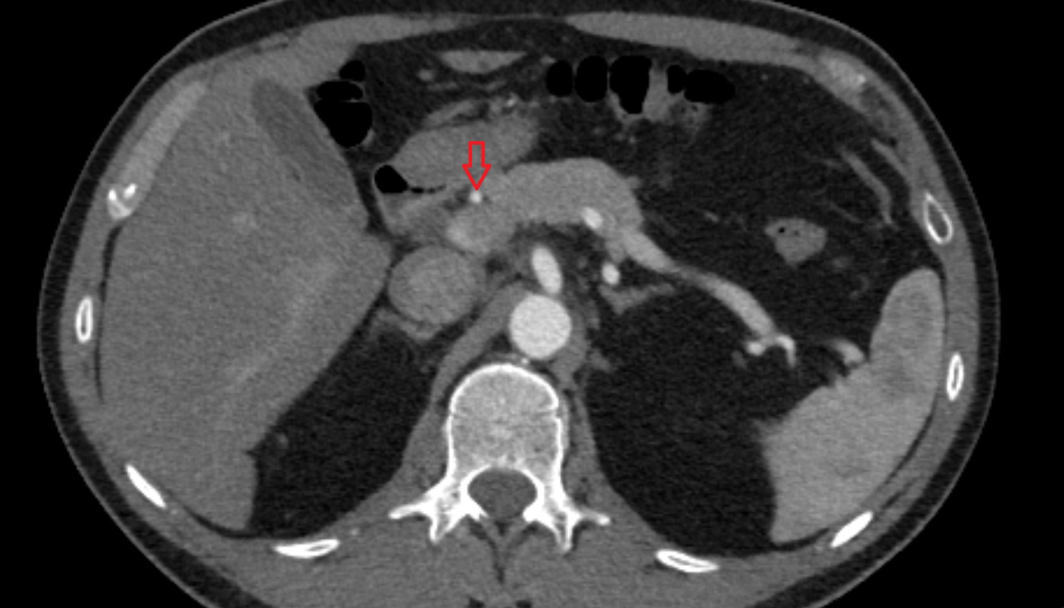 gastroduodenal artery anantomy  CT axial  image -img-00000-00000
