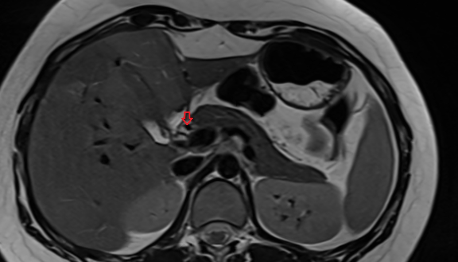 gastroduodenal artery anantomy MRI AXIAL  image -img-00000-00000_00001