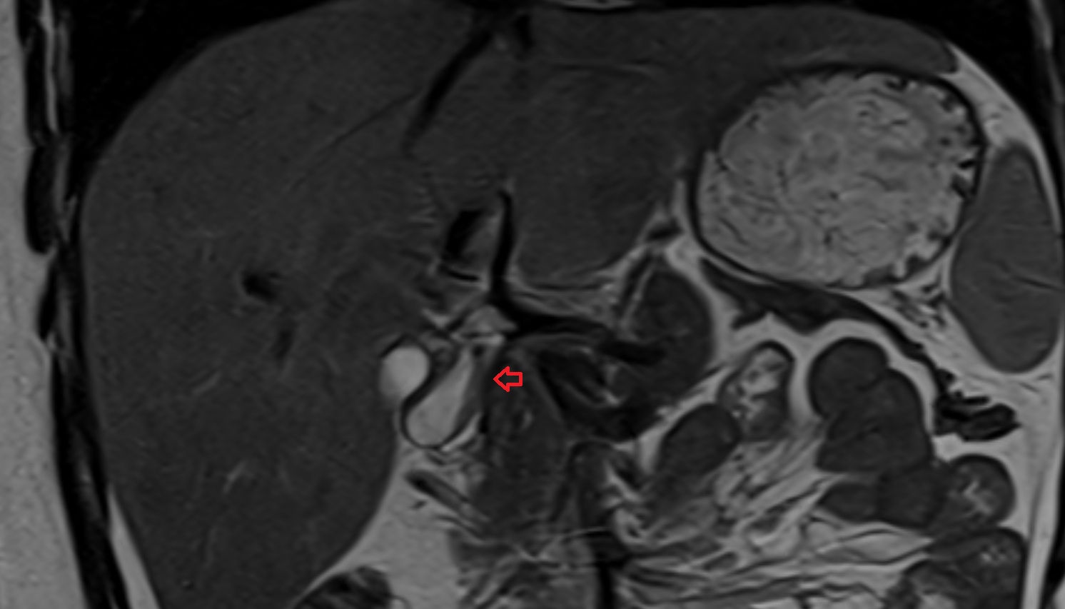 gastroduodenal artery anantomy MRI CORONAL  image -img-00000-00000