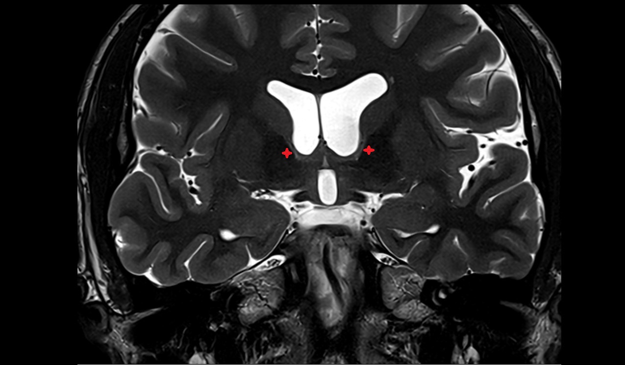 genu of internal capsule mri 3t coronal image